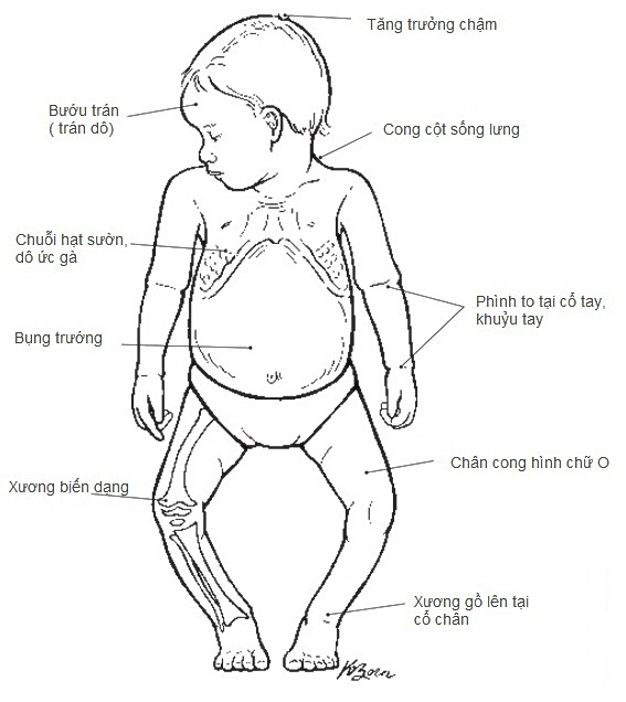 Bệnh Còi Xương ở Trẻ Em | Đông Y Lang Tòng