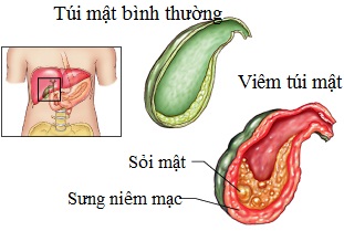 viêm túi mật