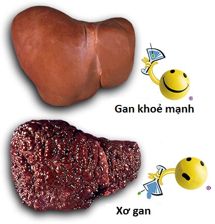 xơ gan